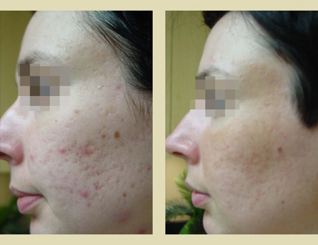 Fraxel laser treatment before & after pictures