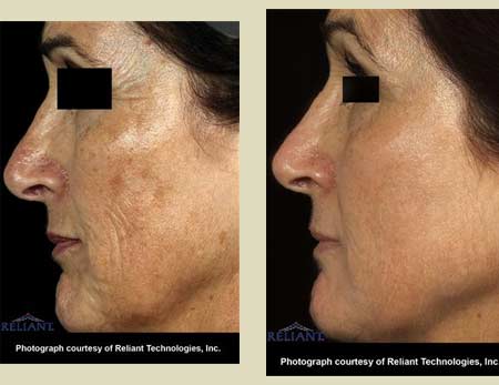 Fraxel laser treatment before & after pictures