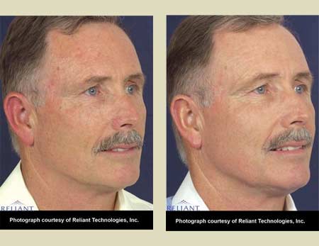 Fraxel laser treatment before & after pictures