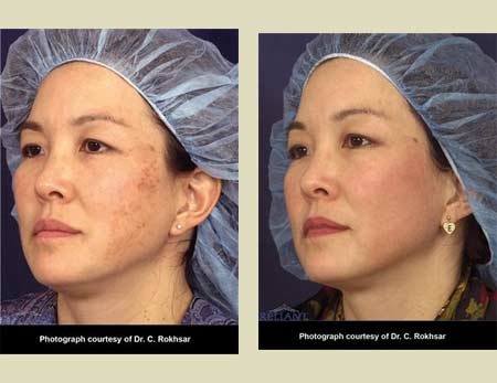 Fraxel laser treatment before & after pictures