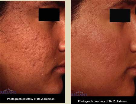 Fraxel laser treatment before & after pictures