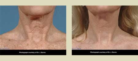 Fraxel laser treatment before & after pictures