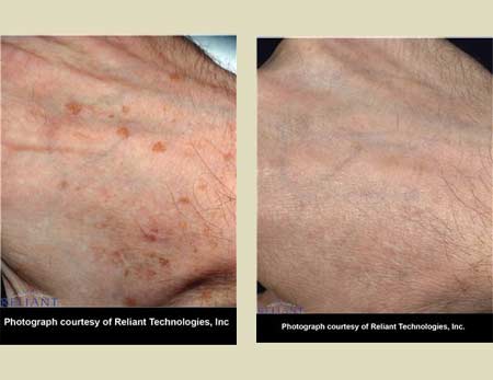 Fraxel laser treatment before & after pictures