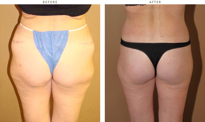 Brazilian Buttock Lift - Before and After Pictures