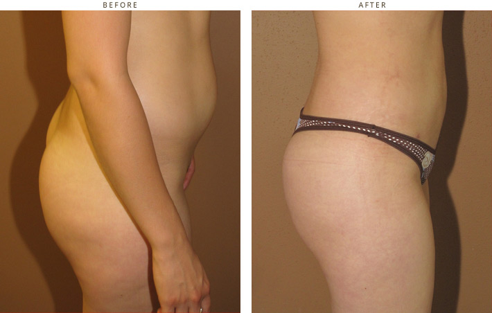 Brazilian Buttock Lift - Before and After Pictures