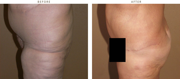 Brazilian Buttock Lift - Before and After Pictures