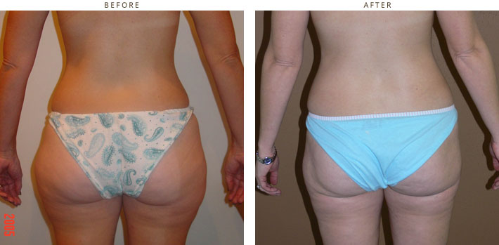 Liposuction – Before & After Pictures