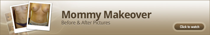 Mommy Makeover – Before and After Pictures