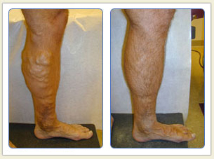 Varicose veins and broken vessels removal 01